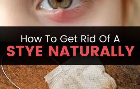 How to Get Rid of a Stye