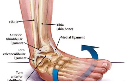 How to Deal with a Sprain