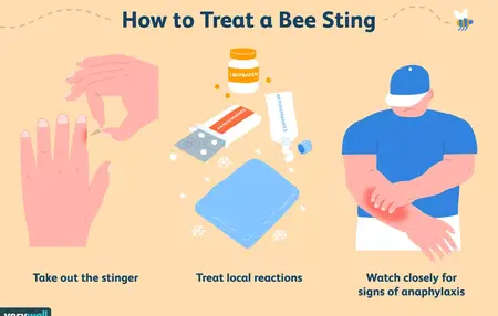 How to Get Rid of a Bee Sting