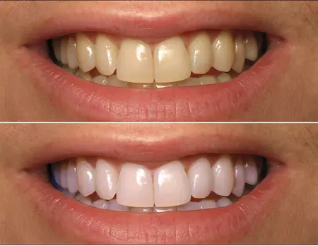 How to Whiten Your Teeth