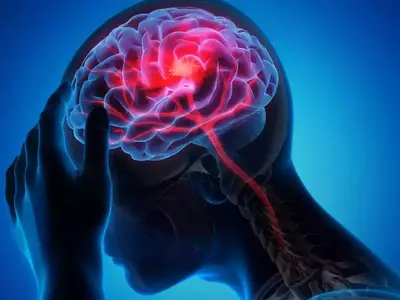 Wajah Mencong: Bedakan Bell's Palsy & Stroke - Kenali Gejalanya!