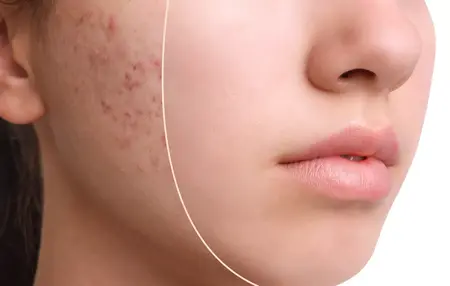 How to Get Rid of Acne