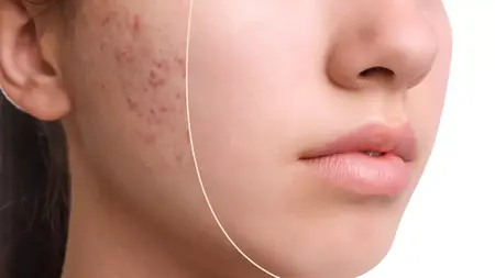 How to Get Rid of Acne