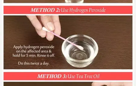 How to Get Rid of a Cold Sore