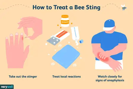 How to Get Rid of a Bee Sting