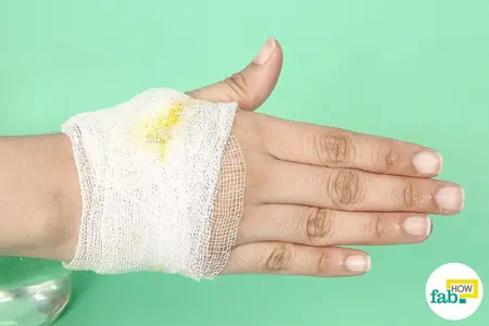 How to Get Rid of a Boil