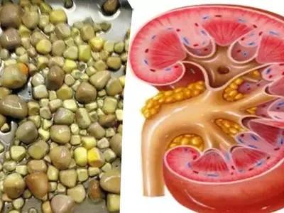 Batu Ginjal: 6 Kebiasaan Sehari-hari yang Harus Dihindari