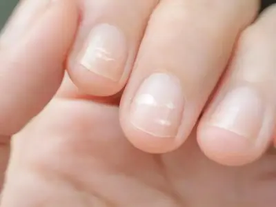 Bintik Putih di Kuku: Penyebab, Fakta & Kapan ke Dokter