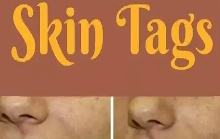 How to Get Rid of Skin Tags