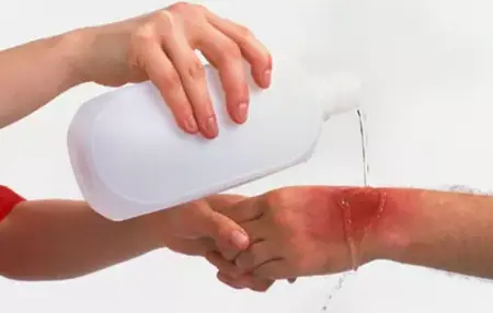 How to Treat a Burn