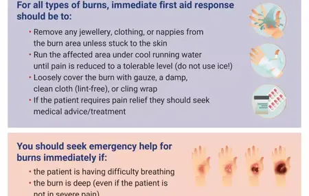 How to Give First Aid for Burns