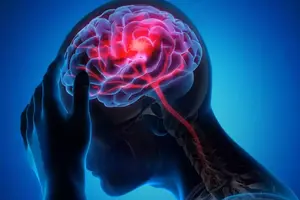 Wajah Mencong: Bedakan Bell's Palsy & Stroke - Kenali Gejalanya!