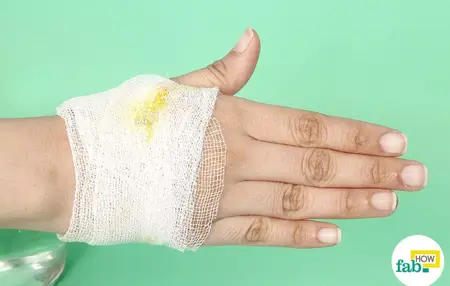 How to Get Rid of a Boil