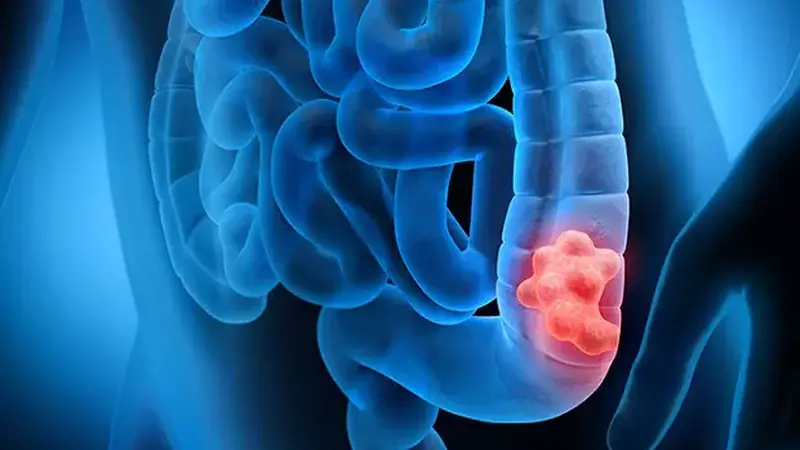 Kanker Usus Besar: Deteksi Dini dengan Skrining & Kolonoskopi