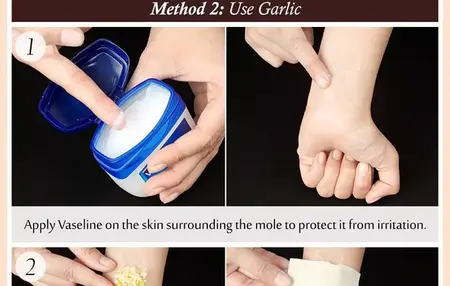 How to Get Rid of a Mole