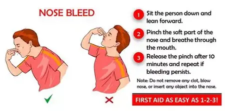 How to Stop a Nosebleed