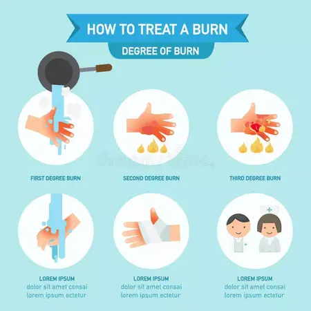 How to treat a burn