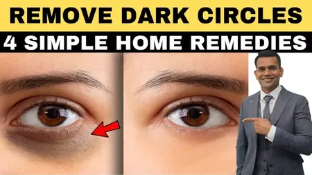 How to Get Rid of Dark Circles Under Eyes