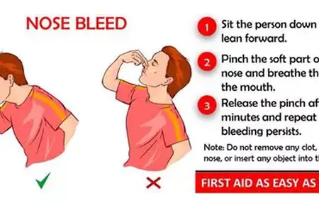 How to Stop a Nosebleed