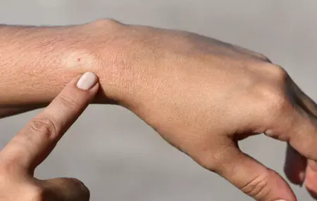 How to Get Rid of a Sting