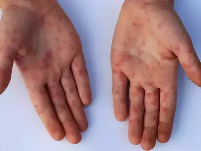 Flu Singapura (HFMD): Aman Mandi, Tapi Isolasi Tetap Penting!